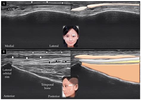 Ultrasound Imaging of the Facial Muscles and Relevance with Botulinum ...