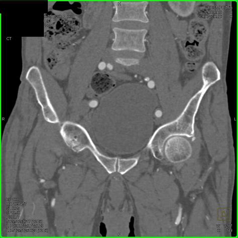 Right Hip Joint Effusion and Normal CTA - Musculoskeletal Radiology ...