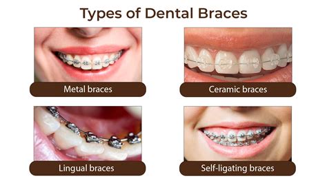 Dental Braces: Types & How They Work - Smile Vizag Dental