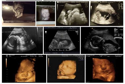 38 Week Pregnancy Ultrasound - I Have An Official Induction Date!