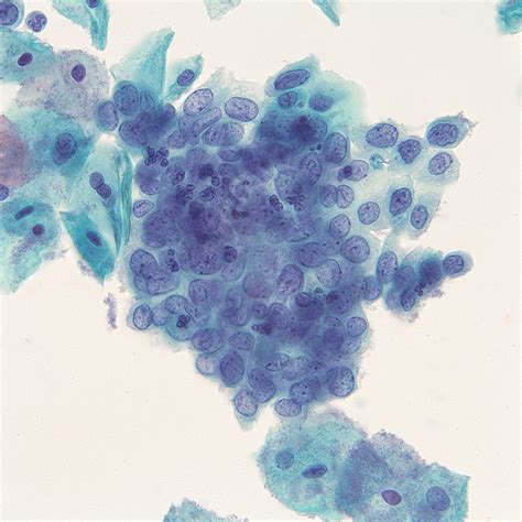 High Grade Squamous Intraepithelial Lesion