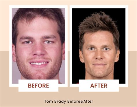 Cosmetic Surgery Tom Brady New Face