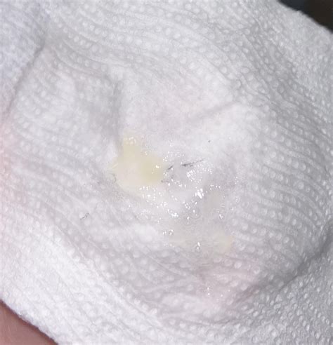 Black specks in phlegm : r/AskDoctorSmeeee