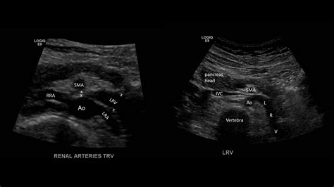 Nutcracker Phenomenon/Syndrome – Sonographic Tendencies
