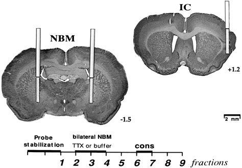 Basal Nucleus Of Meynert