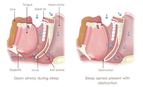 Image result for Obstructive Sleep Apnea