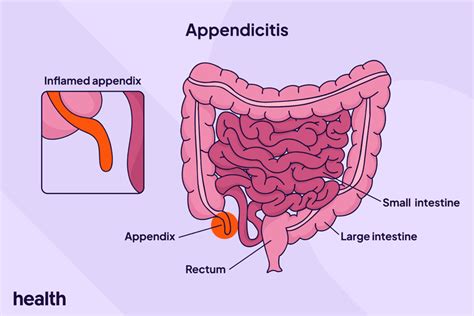 Image result for Appendix Example Website