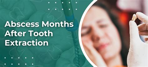 Image result for Abscess Tooth Extraction