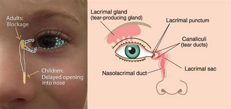 The Watery Eye Causes and Treatment | Paediatric Eye Care