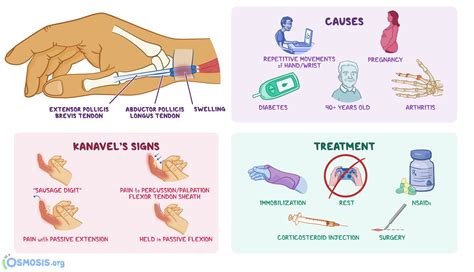 Tenosynovitis: What Is It, de Quervain’s Tenosynovitis, Diagnosis ...