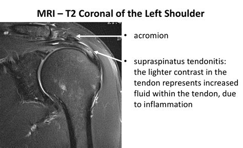 Shoulder Mri Without Contrast
