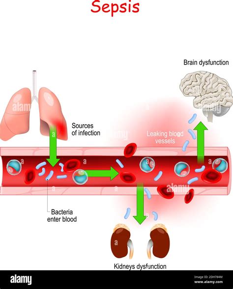 Sepsis. Close-up of cross section of blood vessel with Bacterial ...