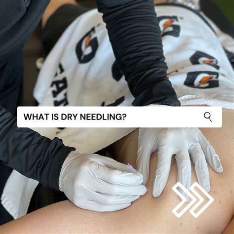Dry Needling | Echo Sports Physical Therapy