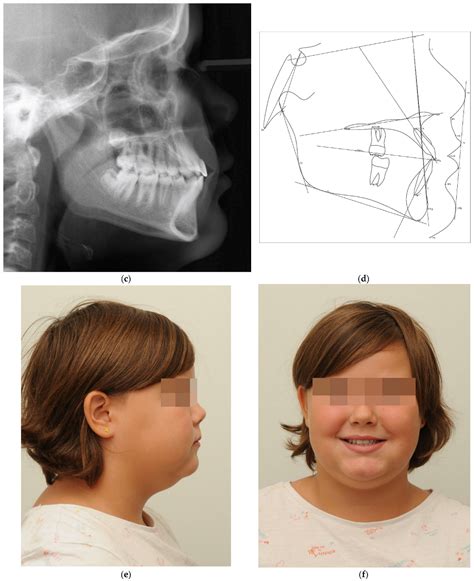 Concept for the Treatment of Class III Anomalies with a Skeletally ...