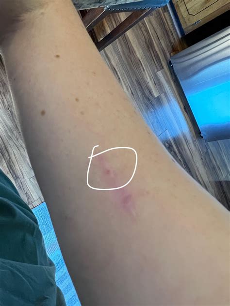 Freckle on wide excision scar : r/Melanoma