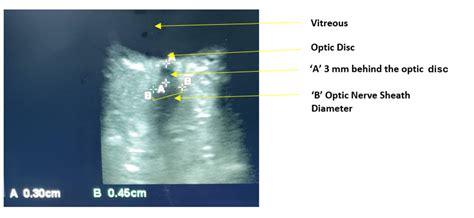 Comparison of Effect of Propofol and Dexmedetomidine on Intracranial ...