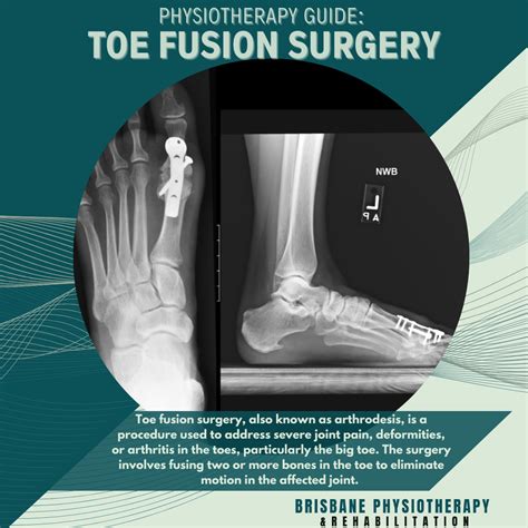 Image result for Toe Surgery