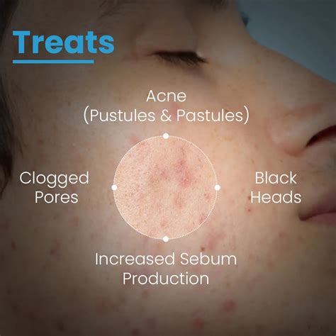 Salicylic & Benzoyl Peroxide Face Wash | FCL Skincare