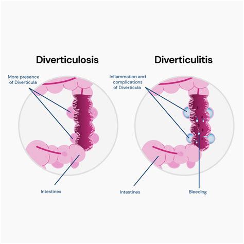 Is Diverticulitis Hereditary? Exploring The Role Of Genes