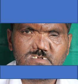 Rehabilitation of an ocular defect with custom ocular prosthesis- A ...