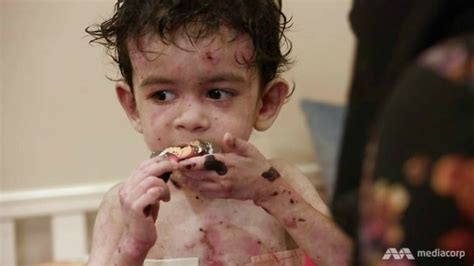 ‘Butterfly Children’ Are Born With The Most Gruesome Disease You’ve ...