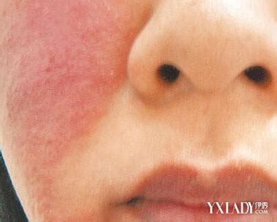 【图】例假期间脸上过敏怎么回事 几种习惯为你消退皮疹(3)_例假期间脸上过敏_伊秀美容网|yxlady.com