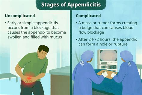 Image result for Appendix Exploded