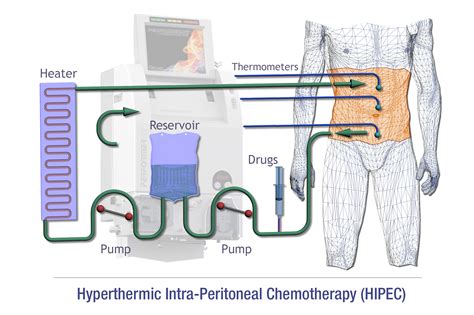 Image result for HIPEC Surgery