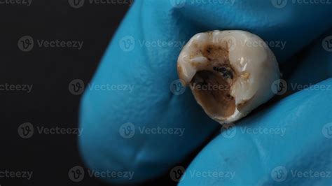 Decayed Tooth Pulling 的图像结果