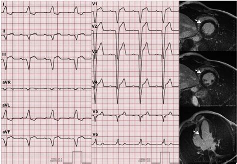 Magnetic Resonance Imaging Correlates of Left Bundle Branch Disease in Patients With Nonischemic ...