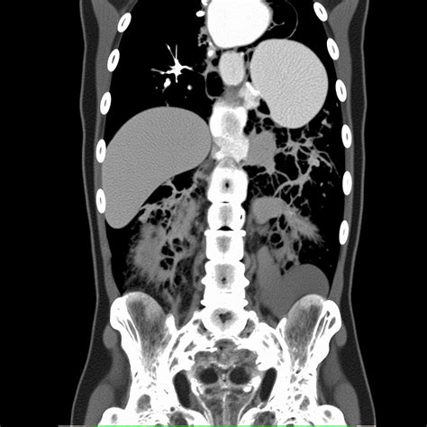 abdominal ct scan showing pancreatic pseudocyst Prompts | Stable ...
