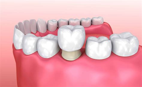 What is a Dental Crown? - Midland Dental Hub
