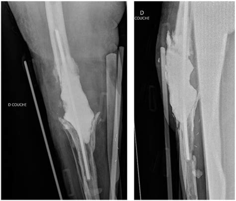 Antimicrobial Regimens in Cement Spacers for Periprosthetic Joint ...