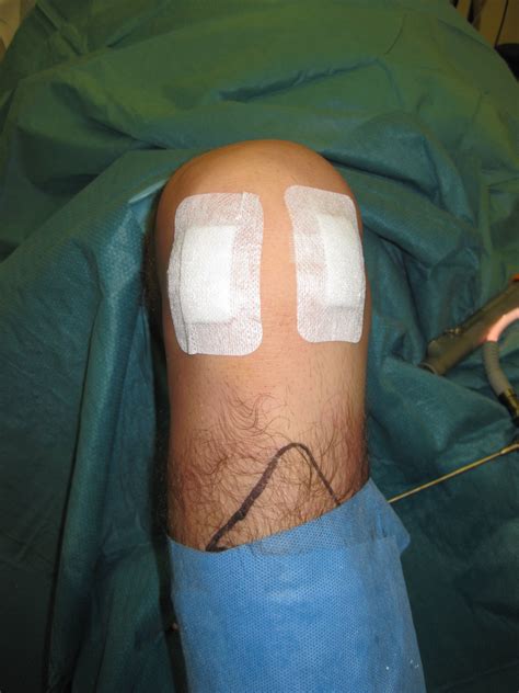 Does Arthroscopic Knee Surgery Hurt at Rhonda Scott blog