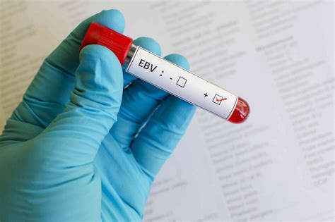 Epstein-Barr Virus Raises Risk of 7 Autoimmune Diseases