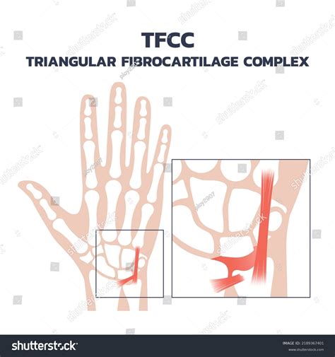1 imágenes de Tfcc tear - Imágenes, fotos y vectores de stock | Shutterstock