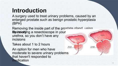 Transurethral Resection of Prostrate (TURP).pptx