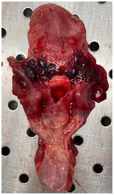 Image result for Famous Cases of Strangulation