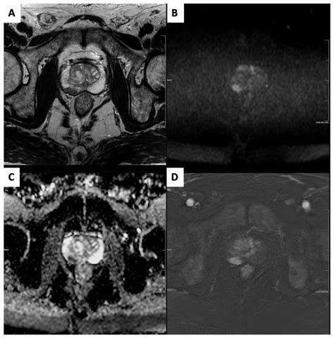 Prostate MRI and PSMA-PET in the Primary Diagnosis of Prostate Cancer