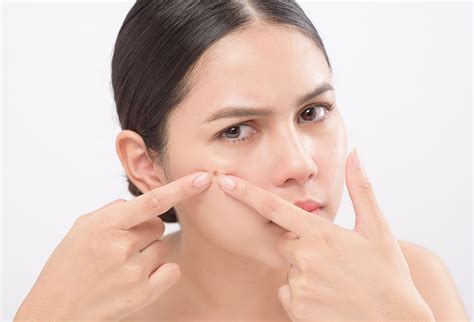 Combat Sudden Breakouts: Quick Fixes, Makeup Tricks, and Long-Term ...