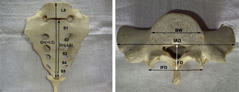 Complete sacralization of L5 vertebrae: traits, dimensions, and load ...