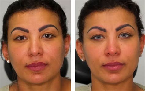 Image result for Eye Color Change Procedure