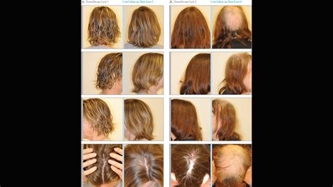 Chemotherapy Side Effects Hair Loss