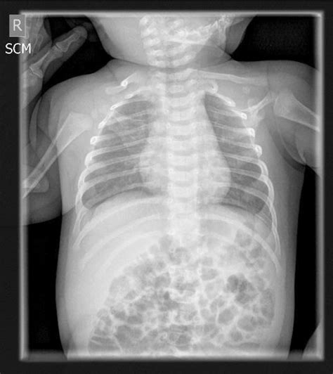 Osteogenesis Imperfecta Baby X Ray