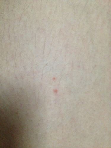 这是HIv早期皮疹吗。6周前有过不洁高危。腿上手上都有 比较小。有的不痒有的会痒。痒的抓后会更痒疹_百度知道