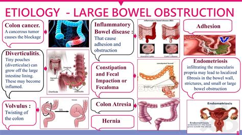 BOWEL OBSTRUCTION.pptx