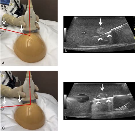 Ultrasound‐Guided Breast Biopsies - Bhatt - 2021 - Journal of Ultrasound in Medicine - Wiley ...