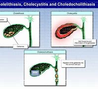 cholelithiasis 的图像结果