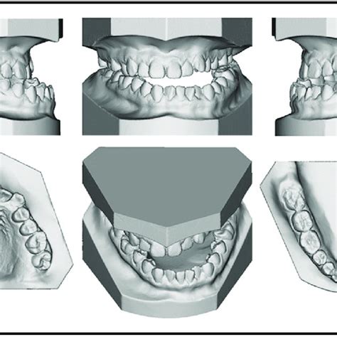 Image result for Intermaxillary Fixation