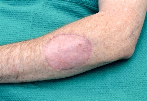 Healing Time For Skin Graft Donor Sites at Neal Marquez blog